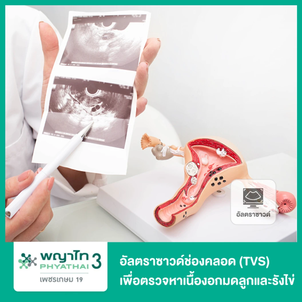 ตรวจรังไข่และมดลูกด้วยการอัลตราซาวด์ทางช่องคลอด (TVS) เพื่อตรวจหาเนื้องอก