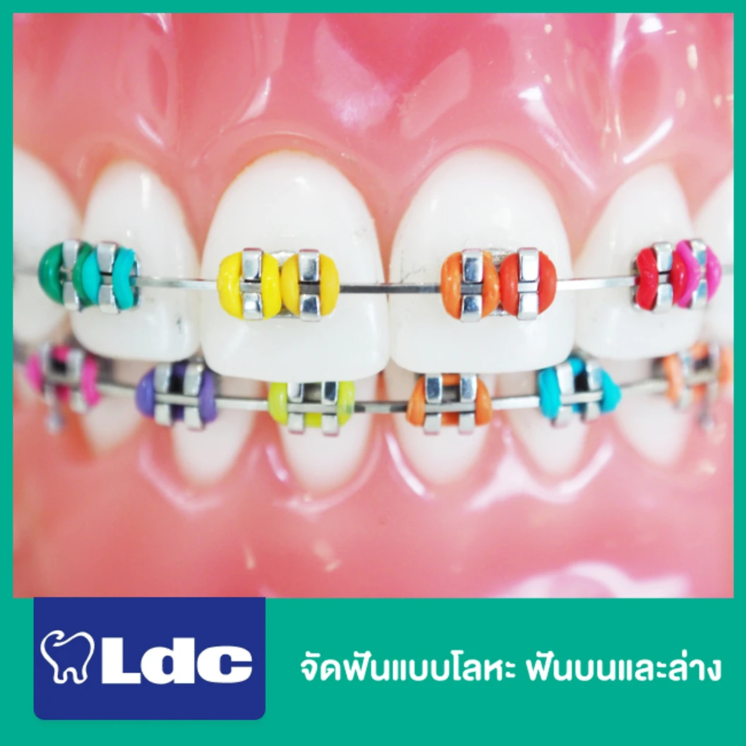 จัดฟันแบบโลหะ ฟันบนและล่าง