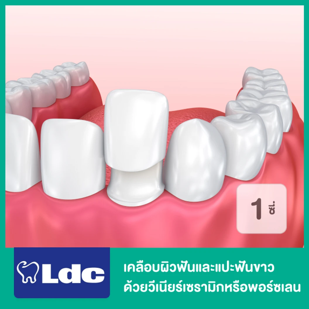 เคลือบผิวฟันและแปะฟันขาว ด้วยวีเนียร์เซรามิกหรือพอร์ซเลน 1 ซี่