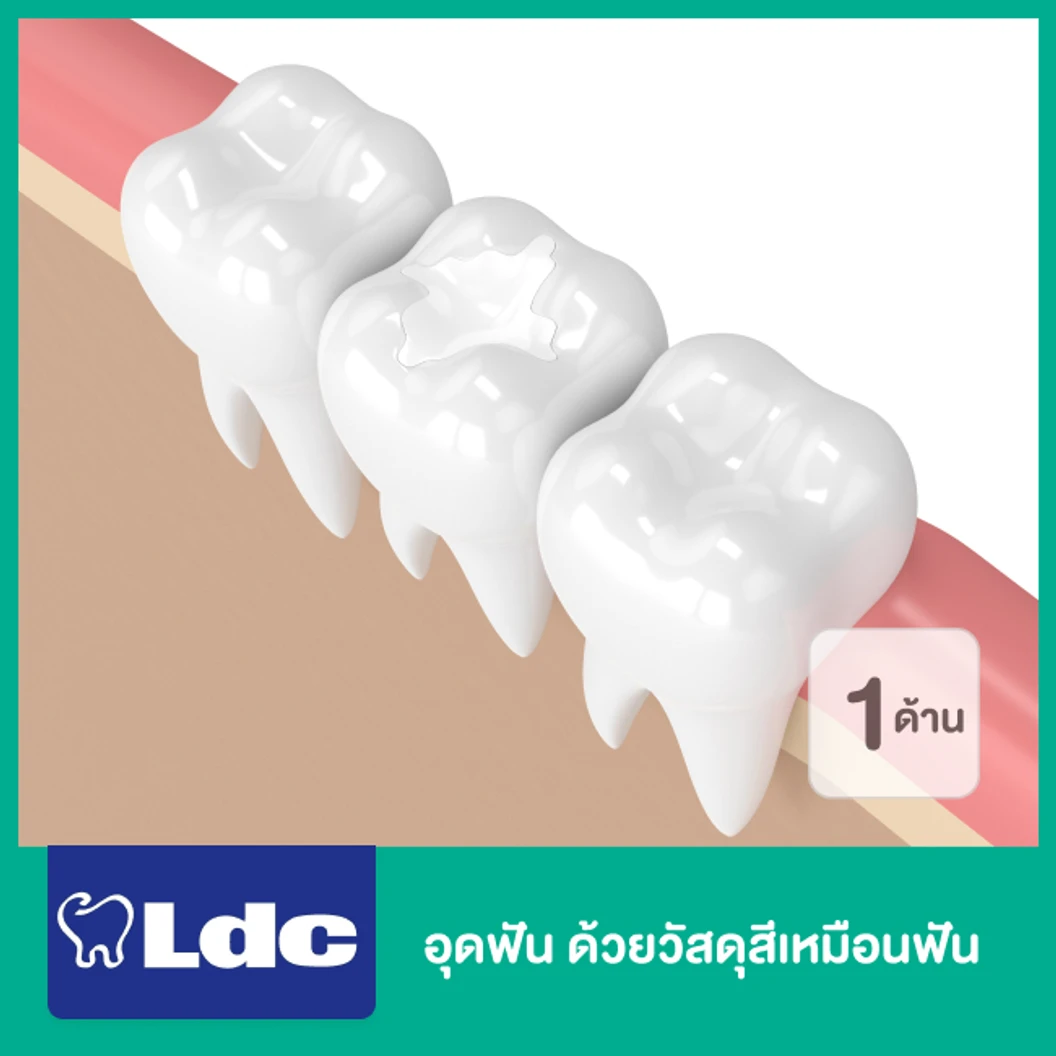 อุดฟัน 1 ด้าน ด้วยวัสดุสีเหมือนฟัน