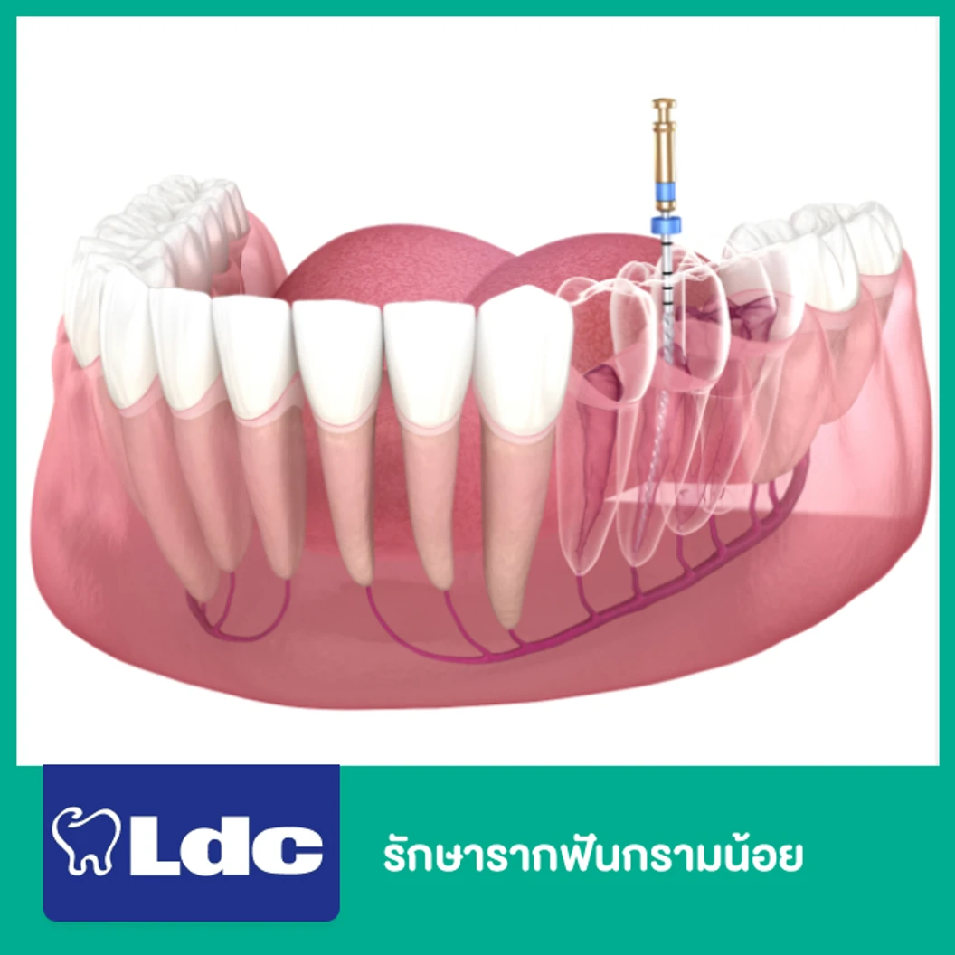 รักษารากฟันกรามน้อย