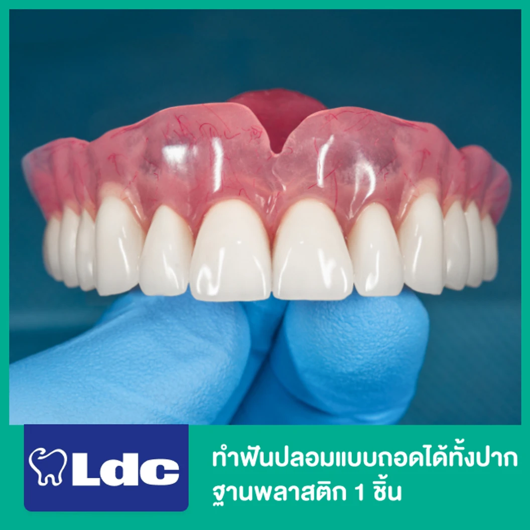 ทำฟันปลอมแบบถอดได้ทั้งปาก ฐานพลาสติก 1 ชิ้น ฟันบนหรือล่าง