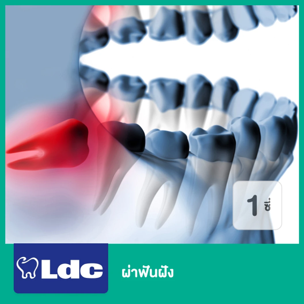 ผ่าฟันฝัง 1 ซี่