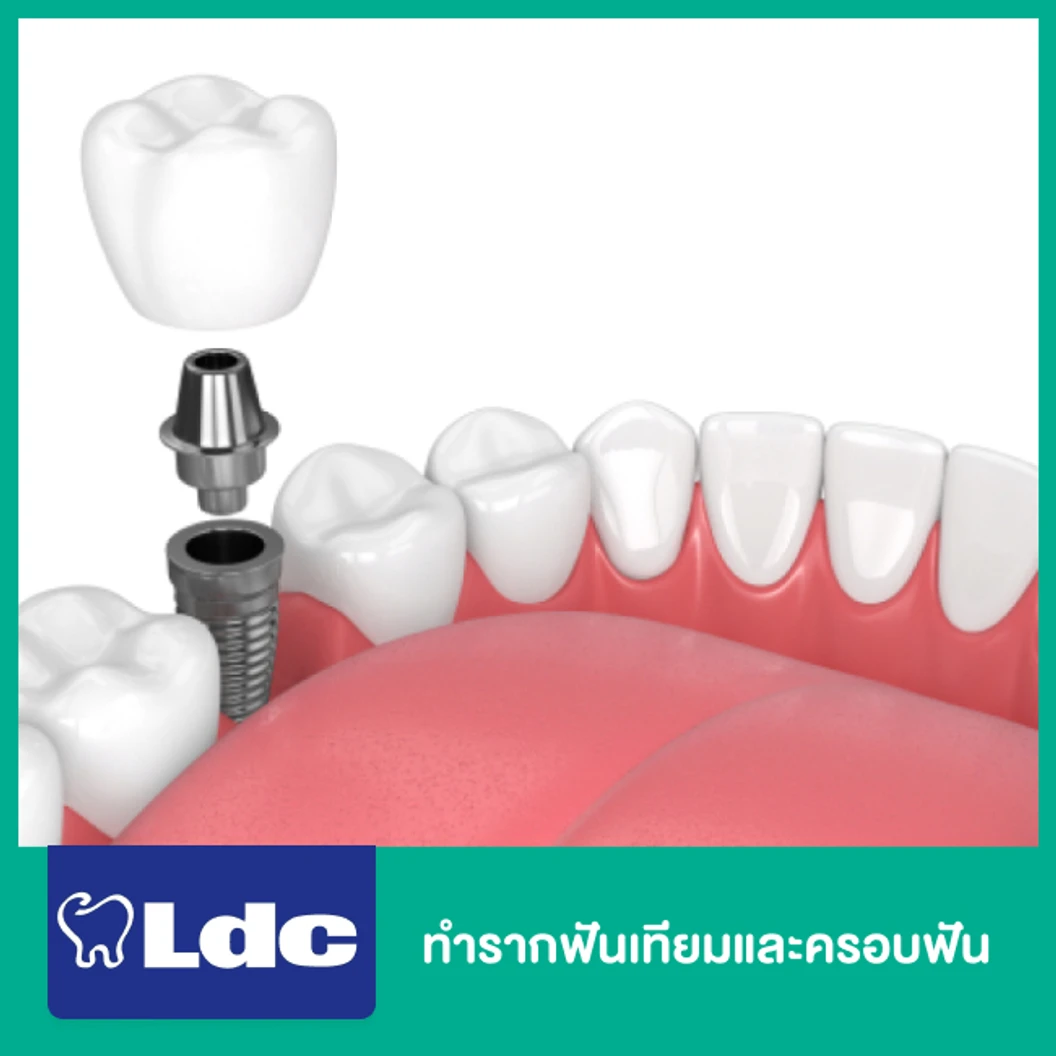 ทำรากฟันเทียมและครอบฟัน