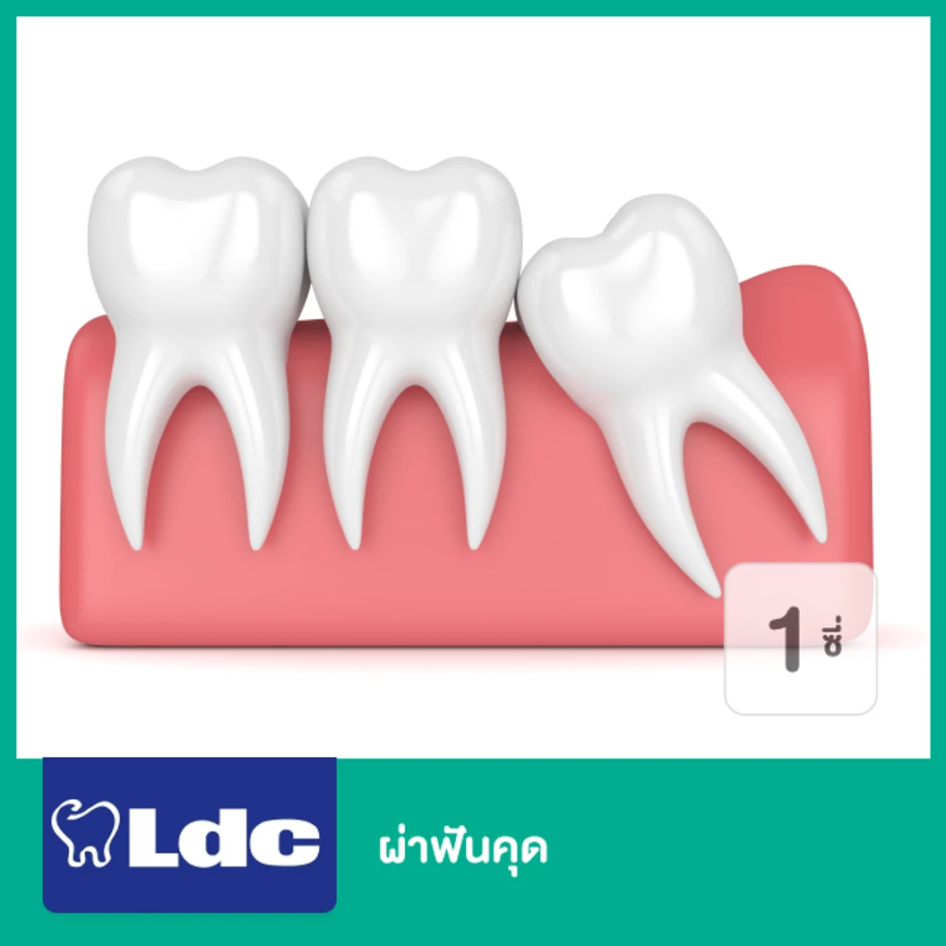 ผ่าฟันคุด 1 ซี่