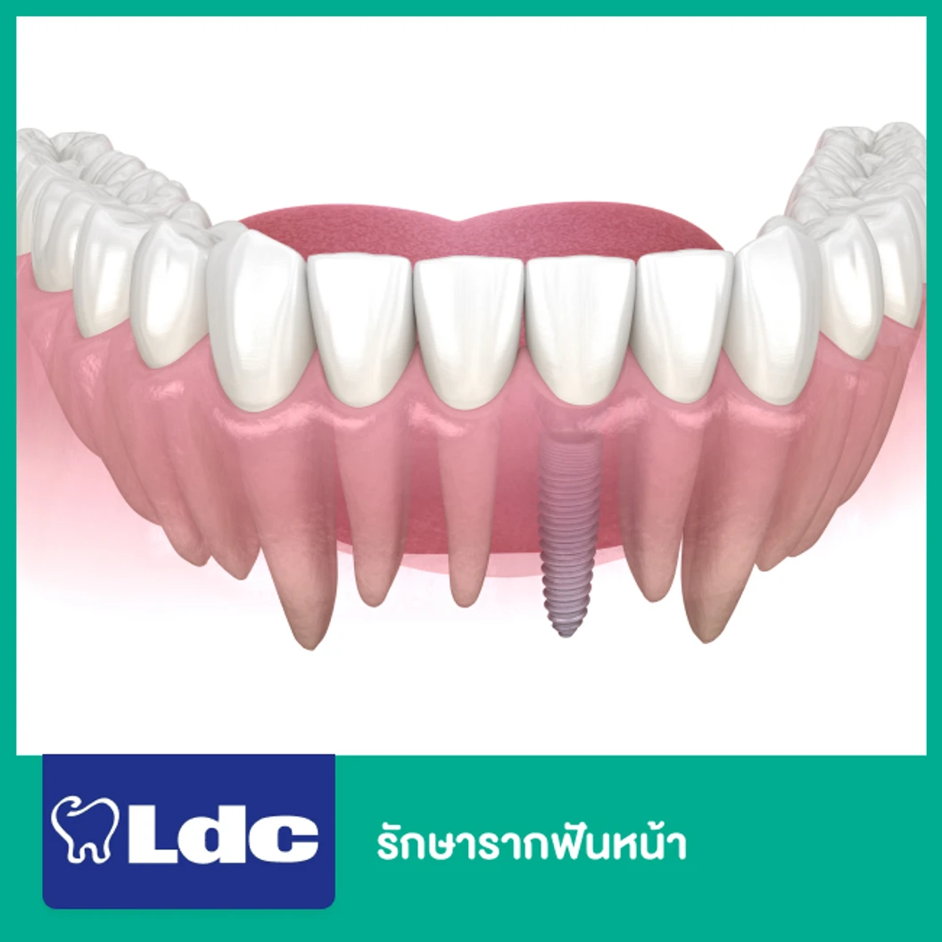 รักษารากฟันหน้า