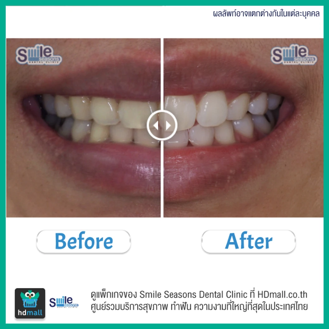 ฟอกสีฟัน ด้วยระบบ Cool Light