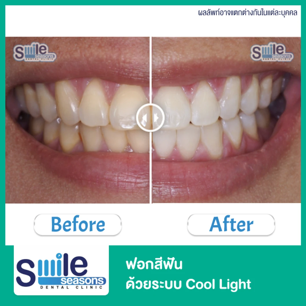 ฟอกสีฟัน ด้วยระบบ Cool Light