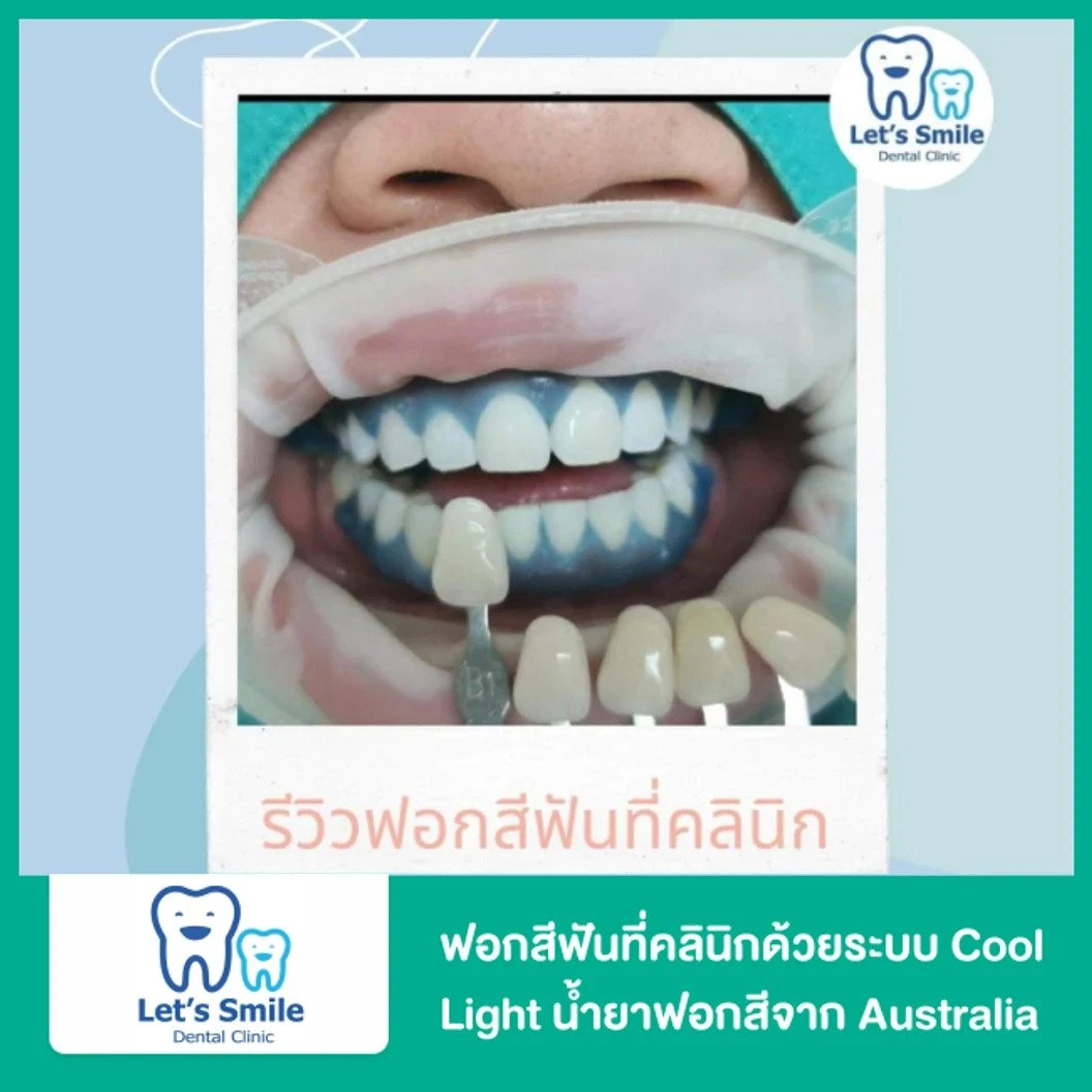 ฟอกสีฟันในคลินิกด้วยระบบ Cool Light น้ำยาฟอกสีนำเข้าจาก Australia