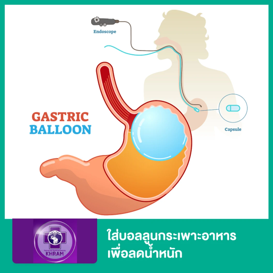 ใส่บอลลูนกระเพาะอาหารเพื่อลดน้ำหนัก (Gastric Balloon)