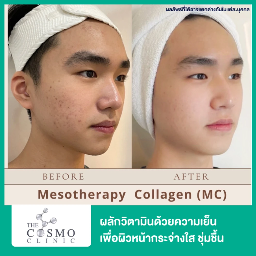 Mesotherapy Collagen ผลักวิตามินด้วยความเย็น เครื่อง Skin Cool เพื่อผิวหน้ากระจ่างใส ชุ่มชื้น กระตุ้นคอลลาเจน 1 ครั้ง ฟรี! มาส์กคอลลาเจน 1 ครั้ง