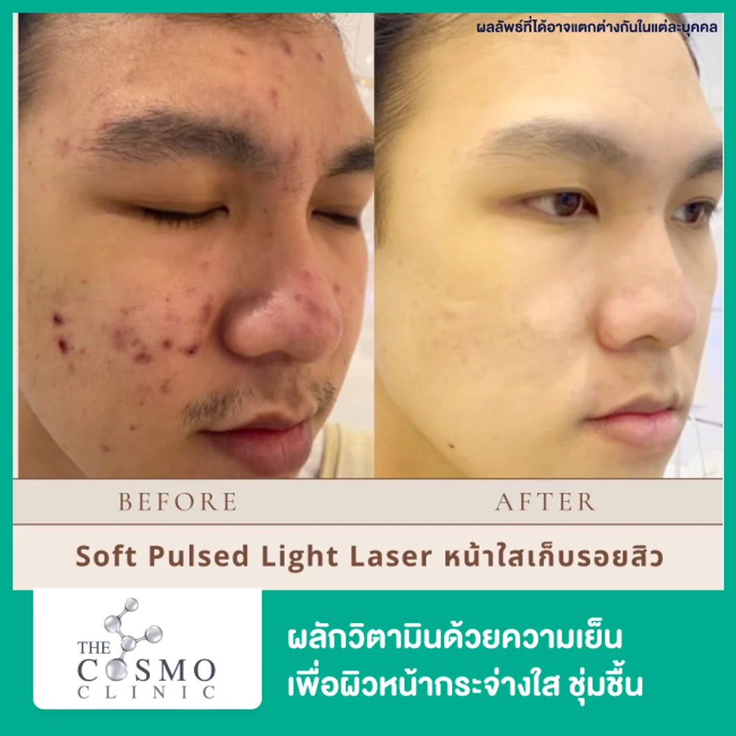 ทำ Soft Pulsed Light ไม่จำกัดช็อต ลดจุดด่างดำและรอยสิว บริเวณใบหน้า 1 ครั้ง