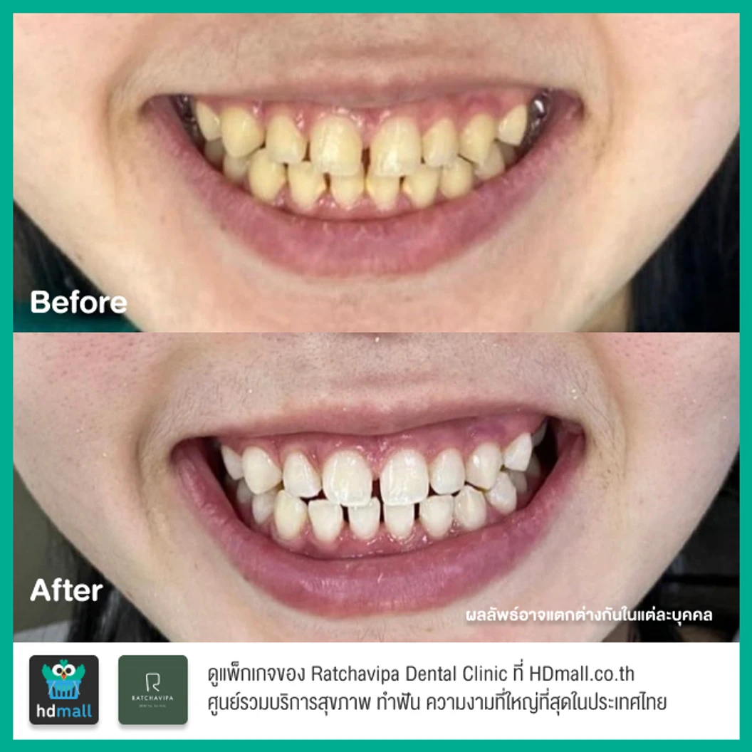 ฟอกสีฟันที่คลินิก ด้วยระบบ Zoom