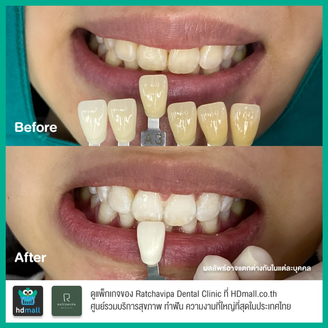 ฟอกสีฟันที่คลินิก ด้วยระบบ Zoom