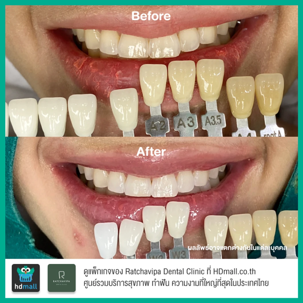 ฟอกสีฟันที่คลินิก ด้วยระบบ Zoom