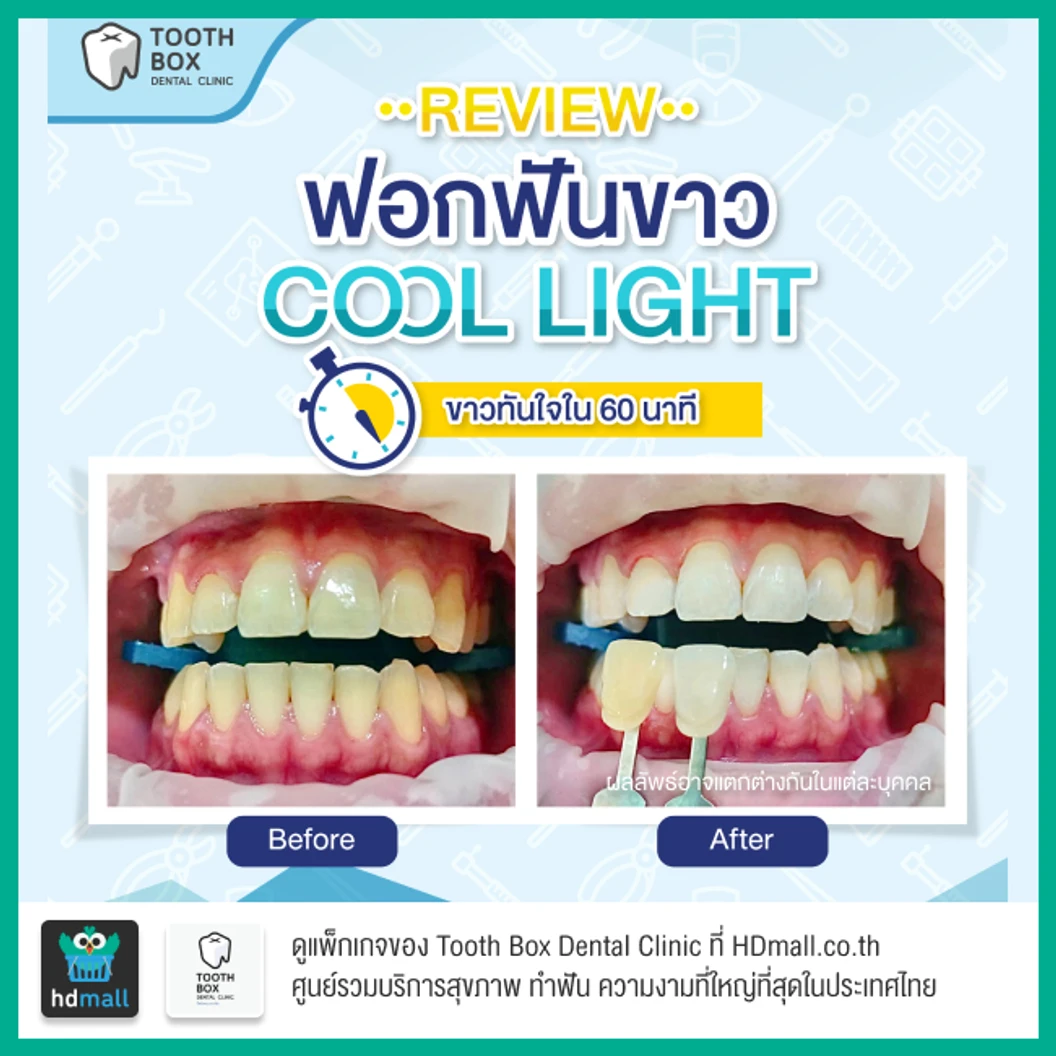 ฟอกสีฟันที่คลินิก ด้วยระบบ Cool Light
