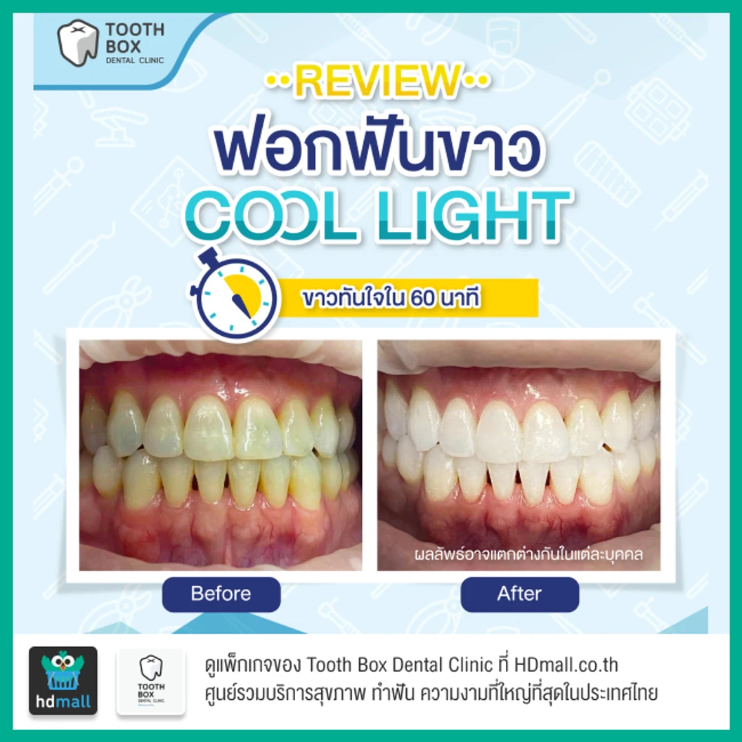 ฟอกสีฟันที่คลินิก ด้วยระบบ Cool Light