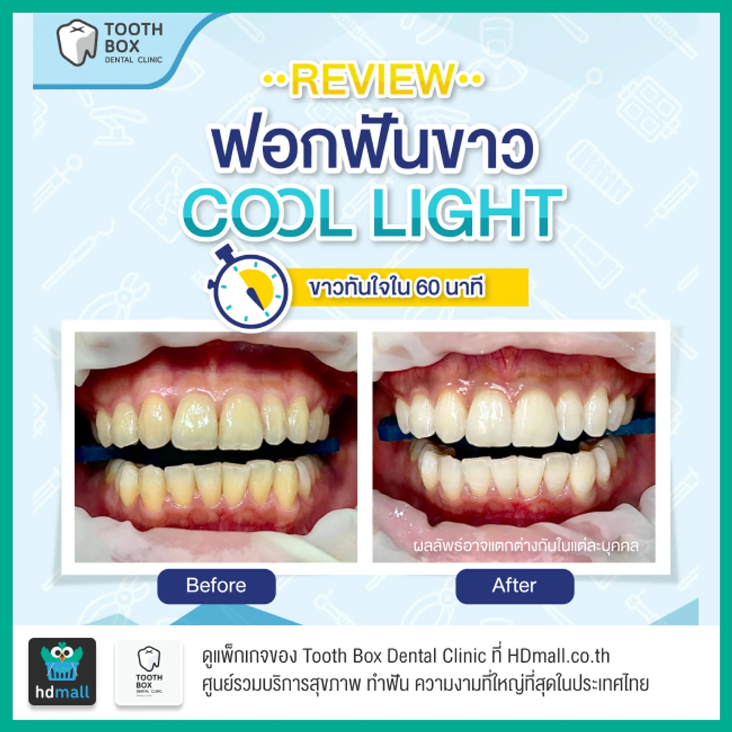 ฟอกสีฟันที่คลินิก ด้วยระบบ Cool Light
