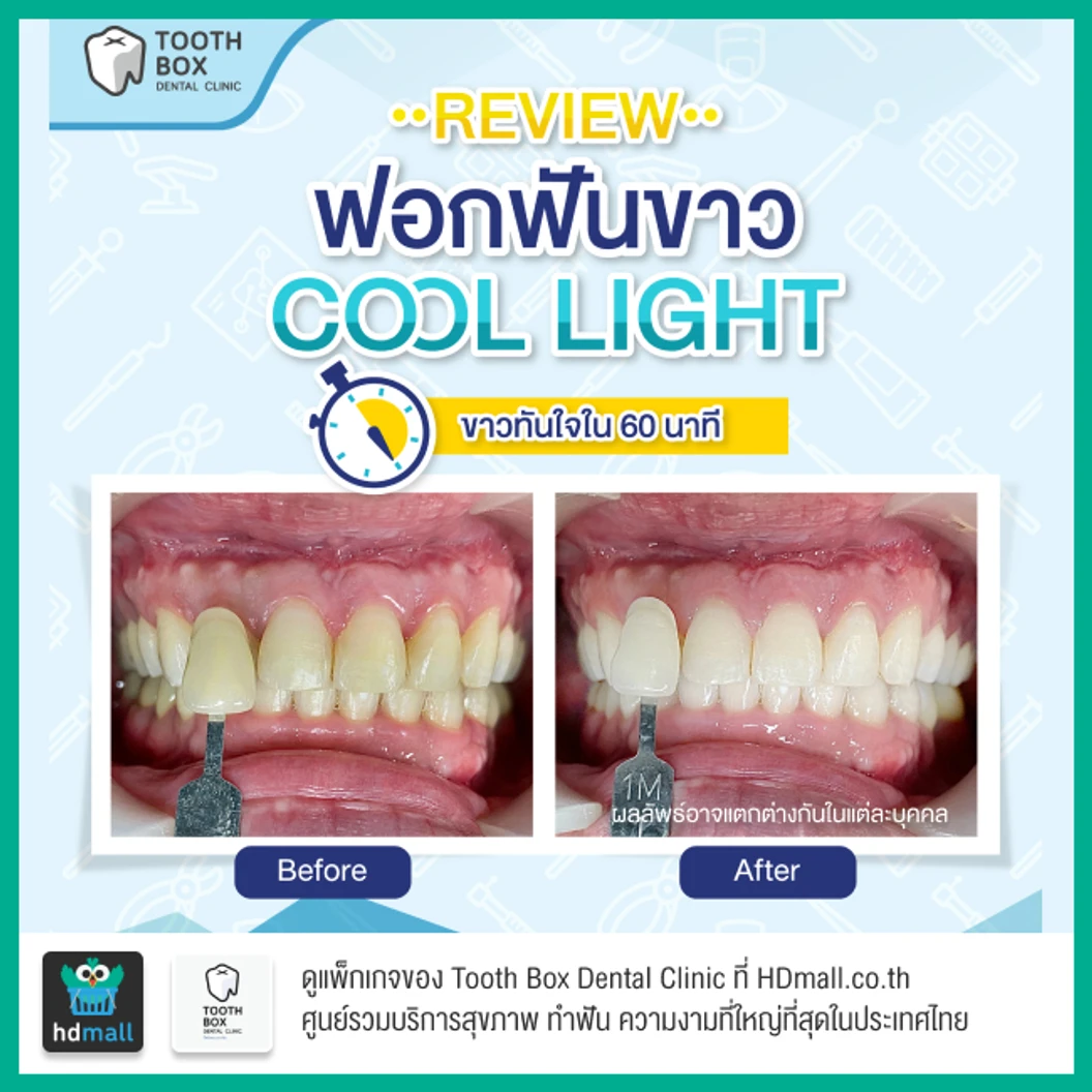 ฟอกสีฟันที่คลินิก ด้วยระบบ Cool Light
