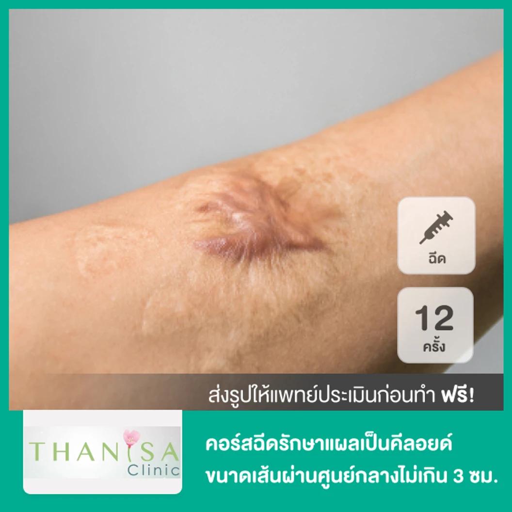 คอร์สฉีดรักษาแผลเป็นคีลอยด์ ขนาดเส้นผ่านศูนย์กลางไม่เกิน 3 ซม. 12 ครั้ง
