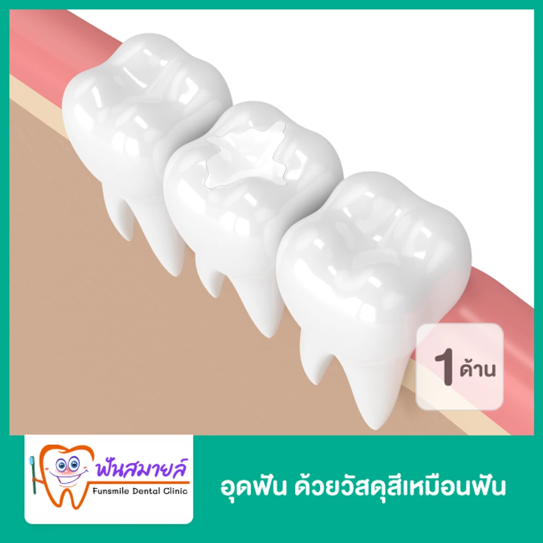 อุดฟัน ด้วยวัสดุสีเหมือนฟัน 1 ด้าน