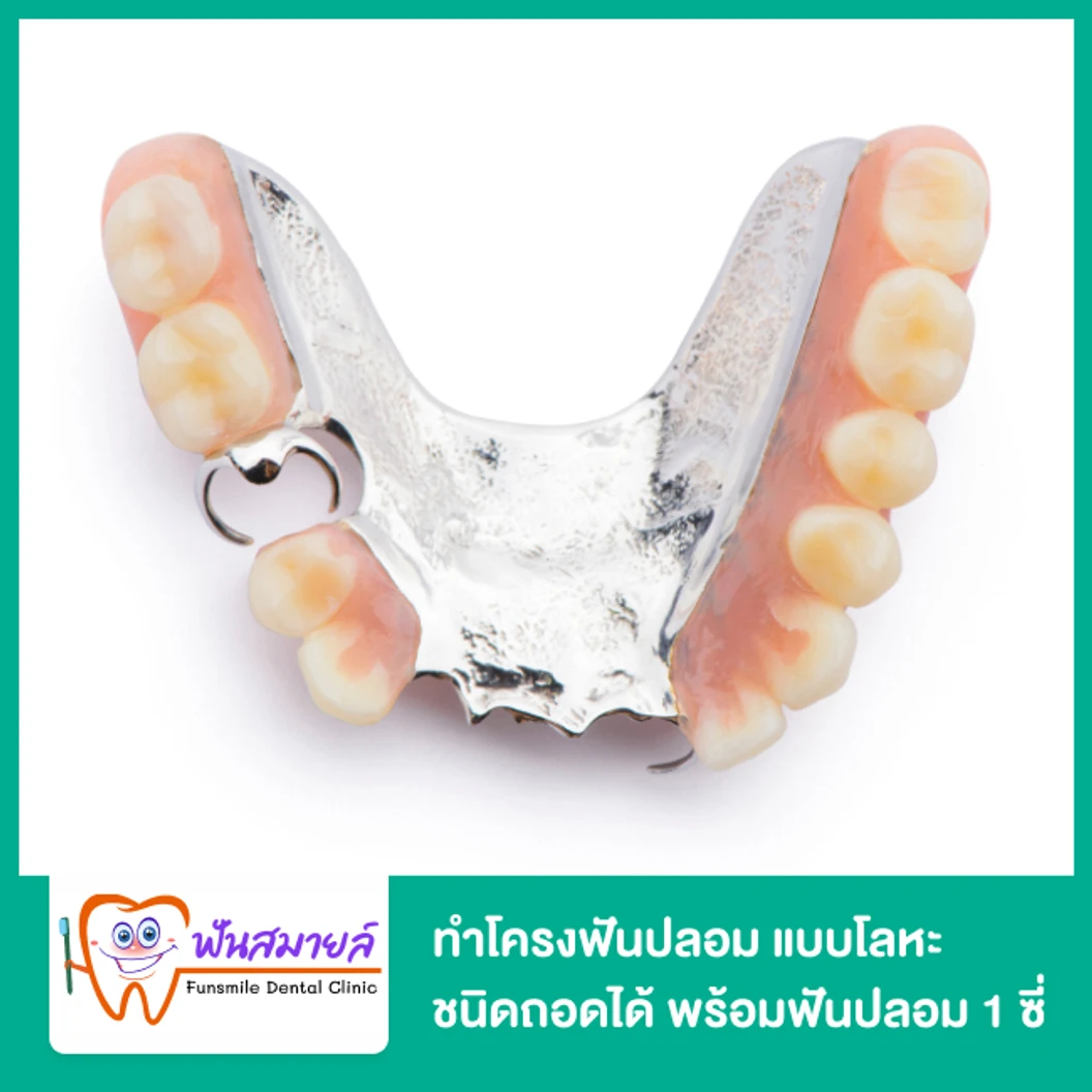 ทำโครงฟันปลอม แบบโลหะ ชนิดถอดได้ พร้อมฟันปลอม 1 ซี่