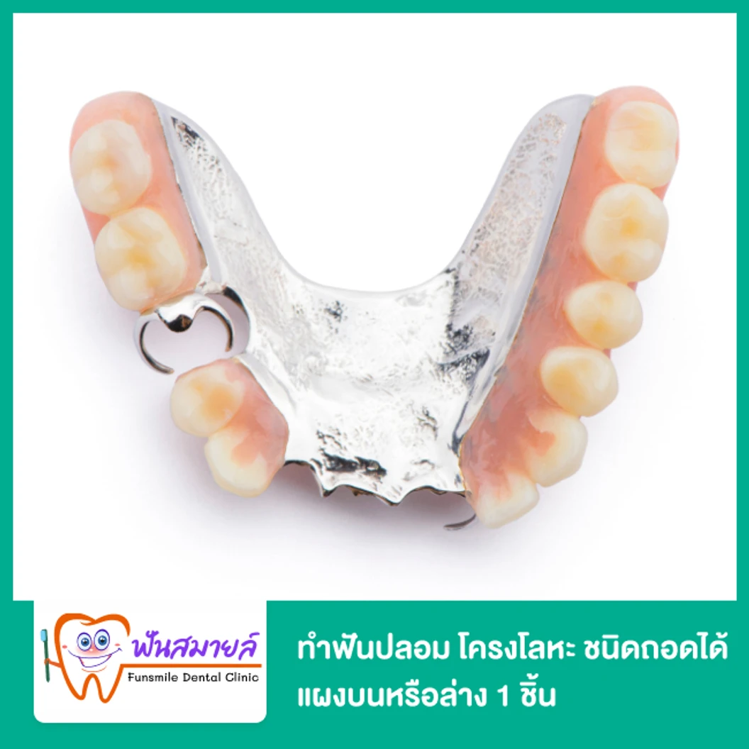 ทำฟันปลอม โครงโลหะ ชนิดถอดได้ แผงบนหรือล่าง 1 ชิ้น