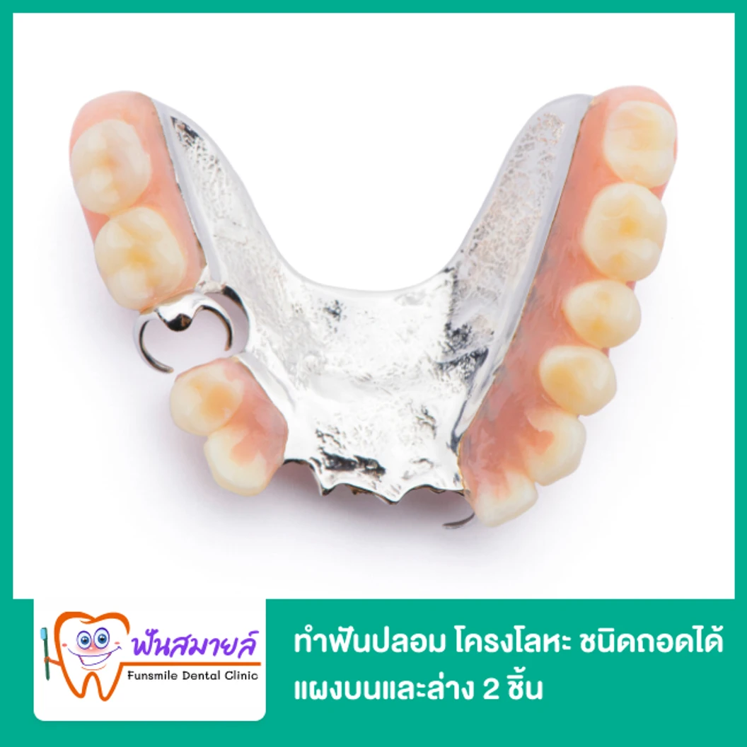 ทำฟันปลอม โครงโลหะ ชนิดถอดได้ แผงบนและล่าง 2 ชิ้น