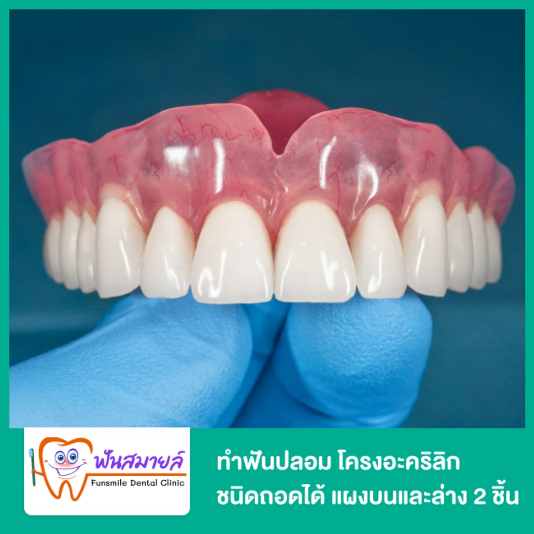 ทำฟันปลอม โครงอะคริลิก ชนิดถอดได้ แผงบนและล่าง 2 ชิ้น