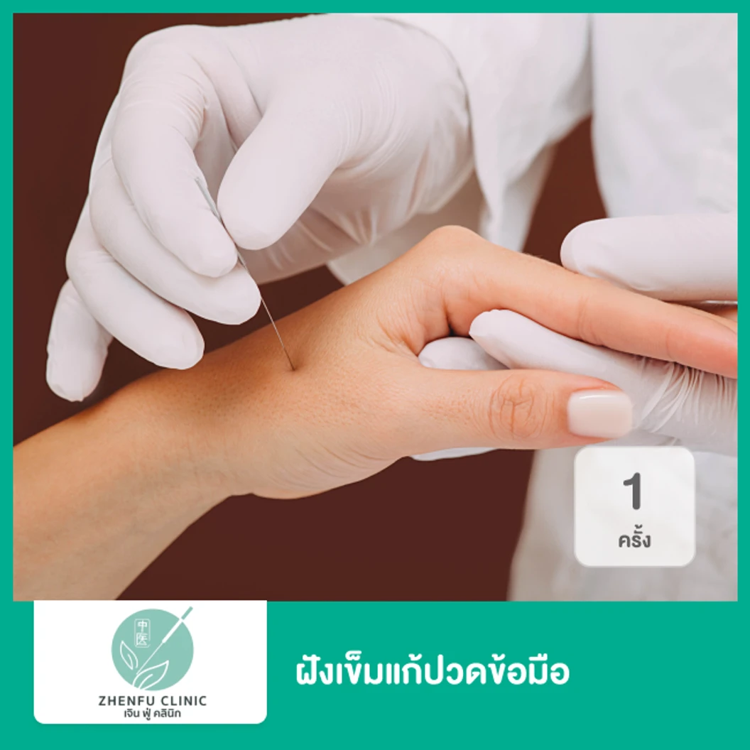 ฝังเข็มแก้ปวดข้อมือ 1 ครั้ง