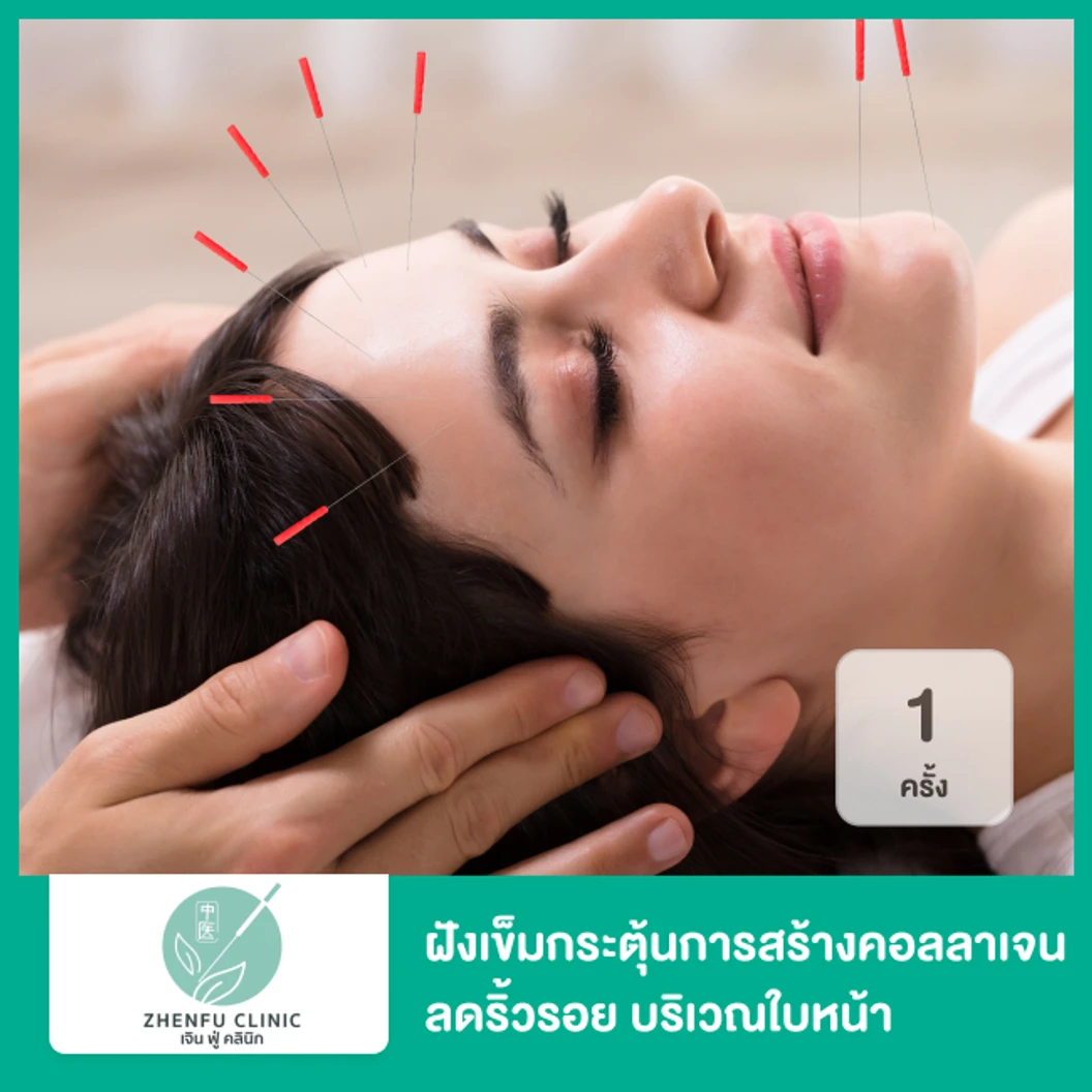 ฝังเข็มกระตุ้นการสร้างคอลลาเจน ลดริ้วรอย บริเวณใบหน้า 1 ครั้ง