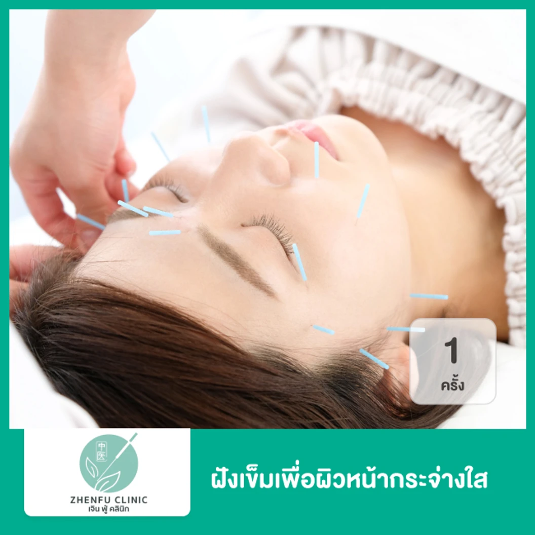 ฝังเข็มเพื่อผิวหน้ากระจ่างใส 1 ครั้ง