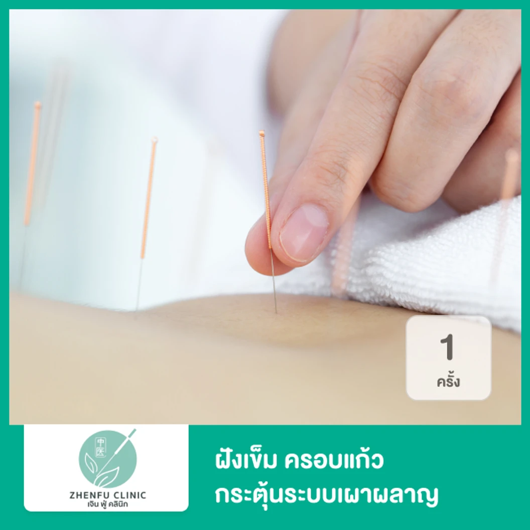 ฝังเข็ม ครอบแก้ว กระตุ้นระบบเผาผลาญ 1 ครั้ง