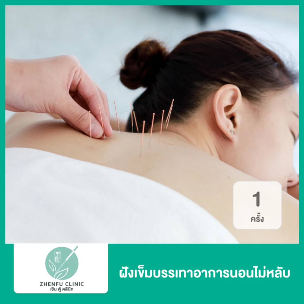 ฝังเข็มบรรเทาอาการนอนไม่หลับ 1 ครั้ง