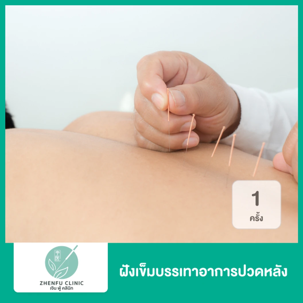 ฝังเข็มบรรเทาอาการปวดหลัง 1 ครั้ง