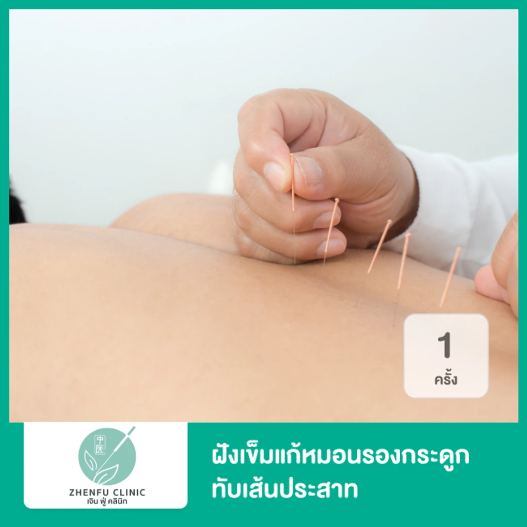 ฝังเข็มแก้หมอนรองกระดูกทับเส้นประสาท 1 ครั้ง