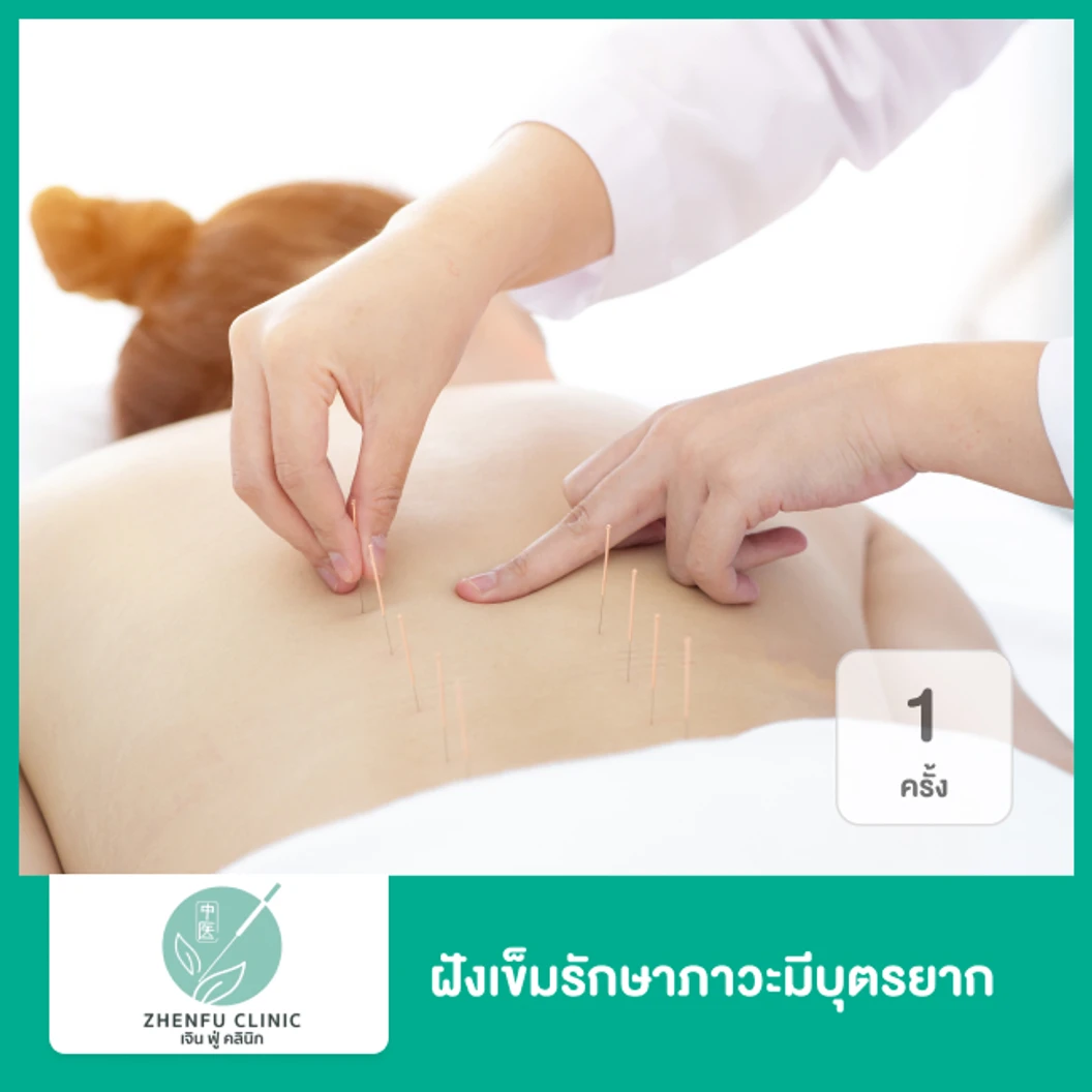 ฝังเข็มรักษาภาวะมีบุตรยาก 1 ครั้ง