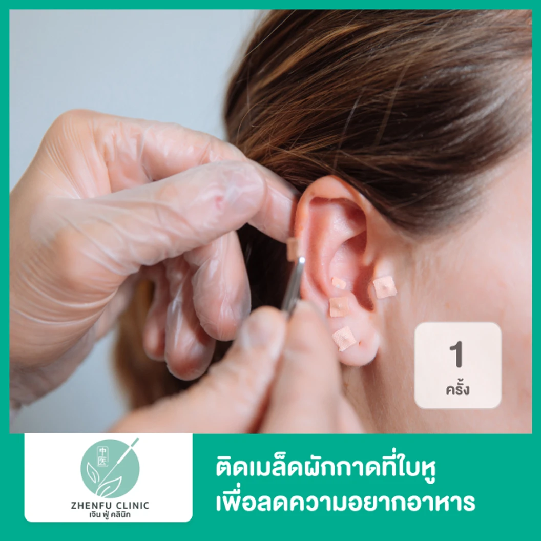 ติดเมล็ดผักกาดที่ใบหู เพื่อลดความอยากอาหาร กระตุ้นการเผาผลาญ 1 ครั้ง