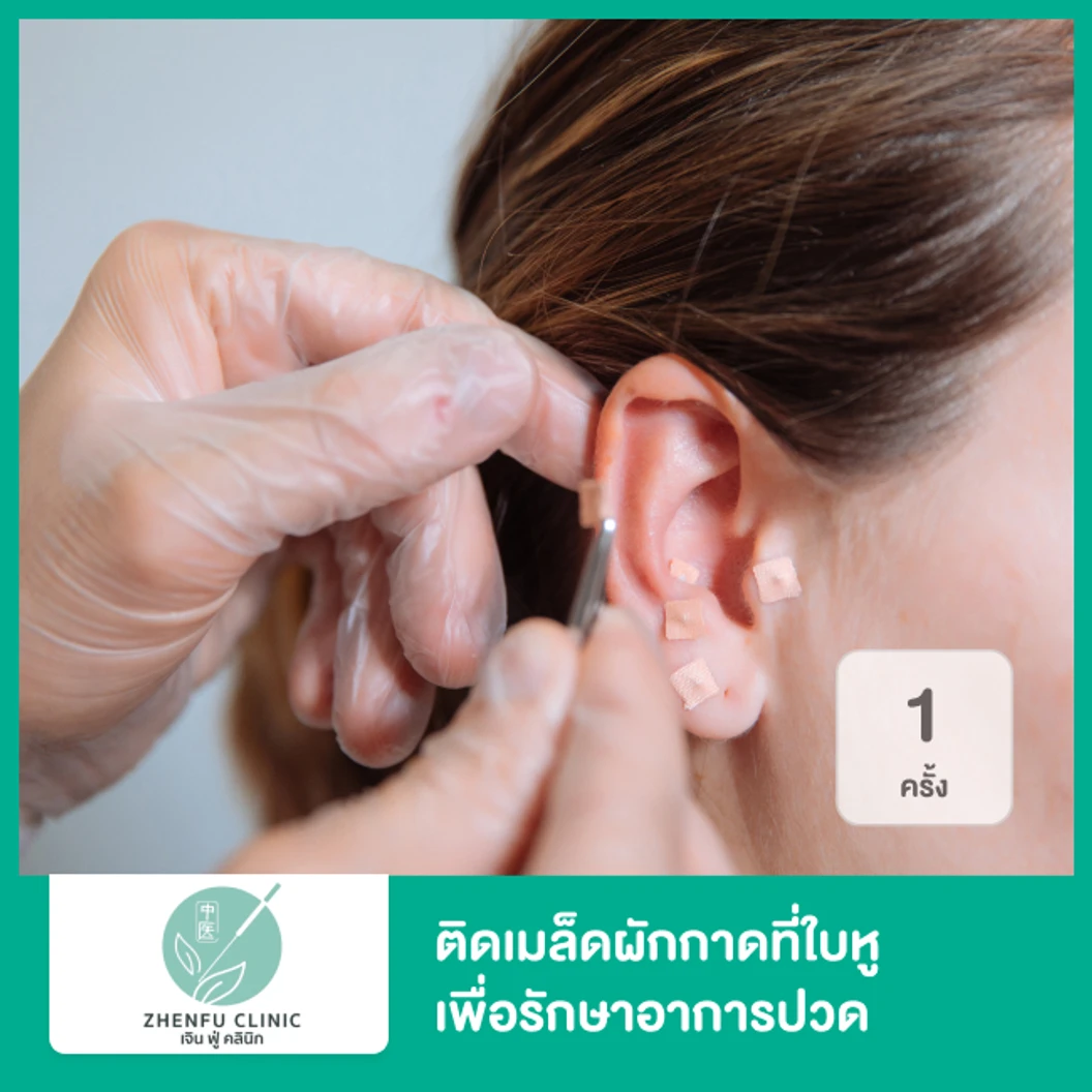 ติดเมล็ดผักกาดที่ใบหู เพื่อรักษาอาการปวด 1 ครั้ง
