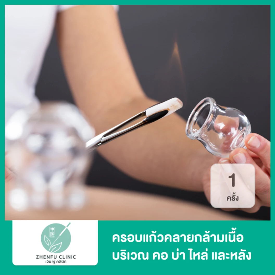 ครอบแก้วคลายกล้ามเนื้อ บริเวณ คอ บ่า ไหล่ และหลัง 1 ครั้ง