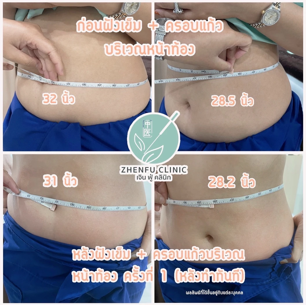 ฝังเข็มใบหน้า ลดฝ้า กระ 1 ครั้ง