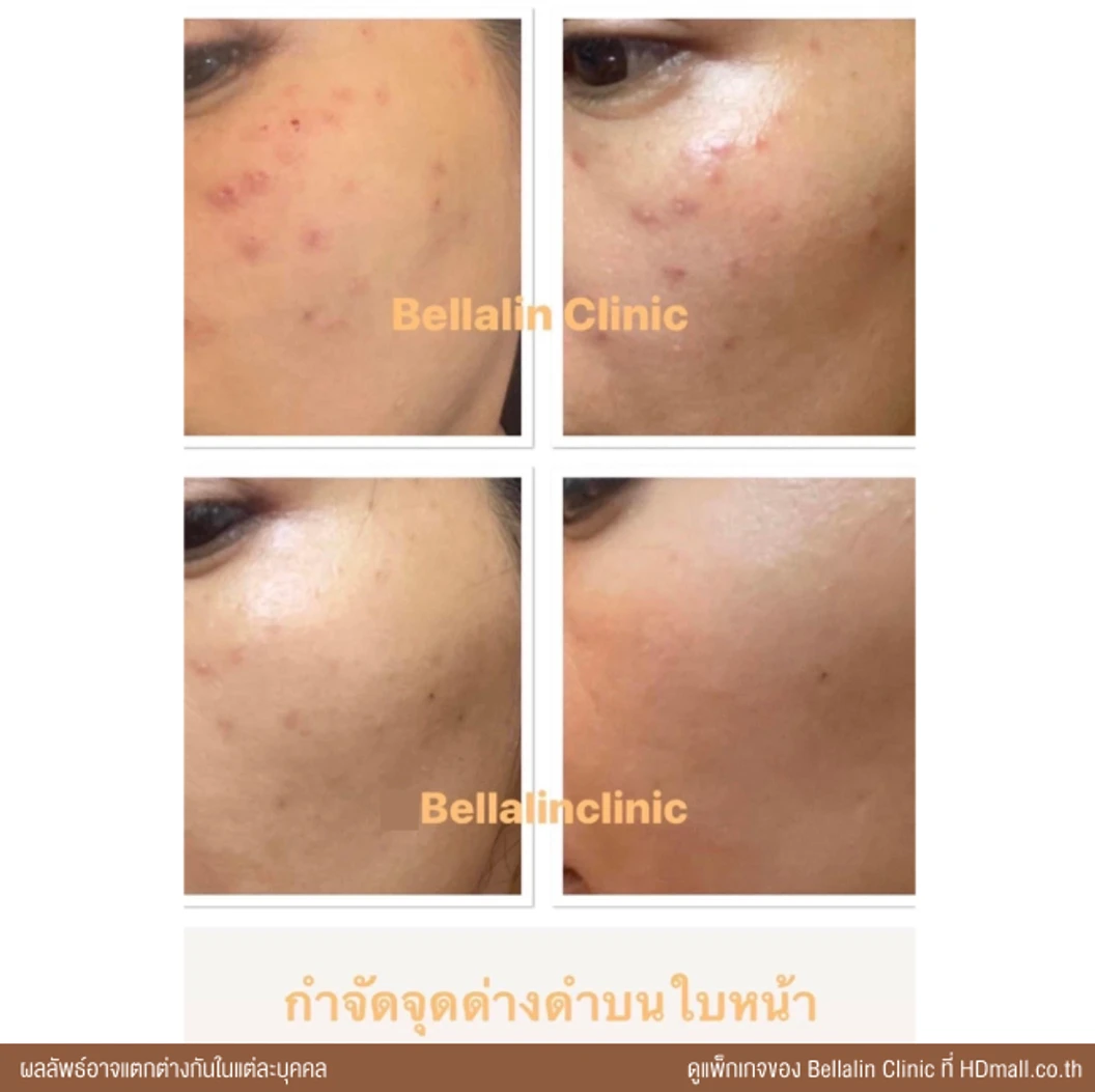 เลเซอร์ Q-Switch ปรับผิวให้กระจ่างใส และลดจุดด่างดำบนใบหน้าไม่จำกัดช็อต ขึ้นอยู่กับแพทย์ประเมิน 1 ครั้ง ฟรี! Collagen Mask 1 ครั้ง มูลค่า 1,500 บาท