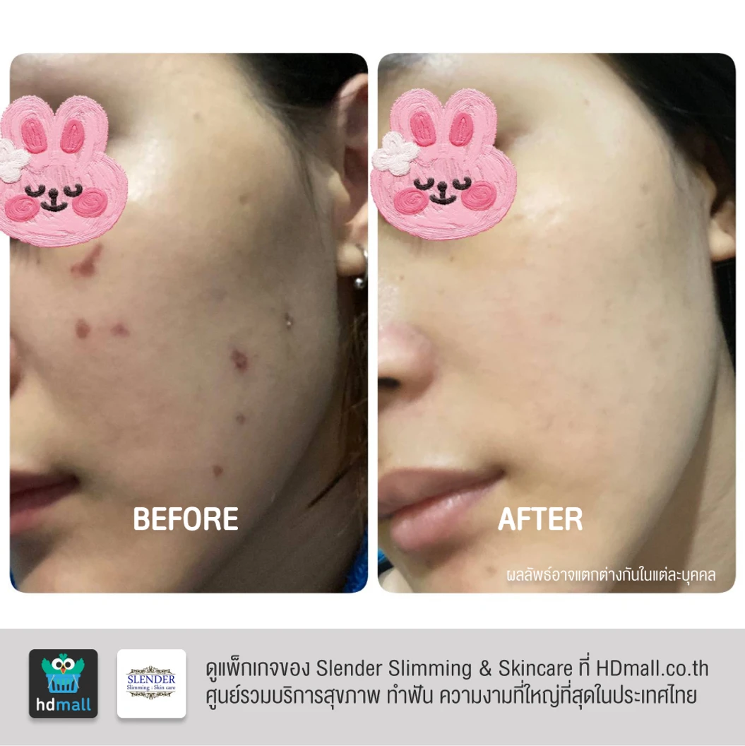 คอร์สฉายแสงฆ่าเชื้อสิว ด้วย Blue Light Laser ลดการอักเสบ ทำให้สิวฝ่อและแห้งลง 2 ครั้ง