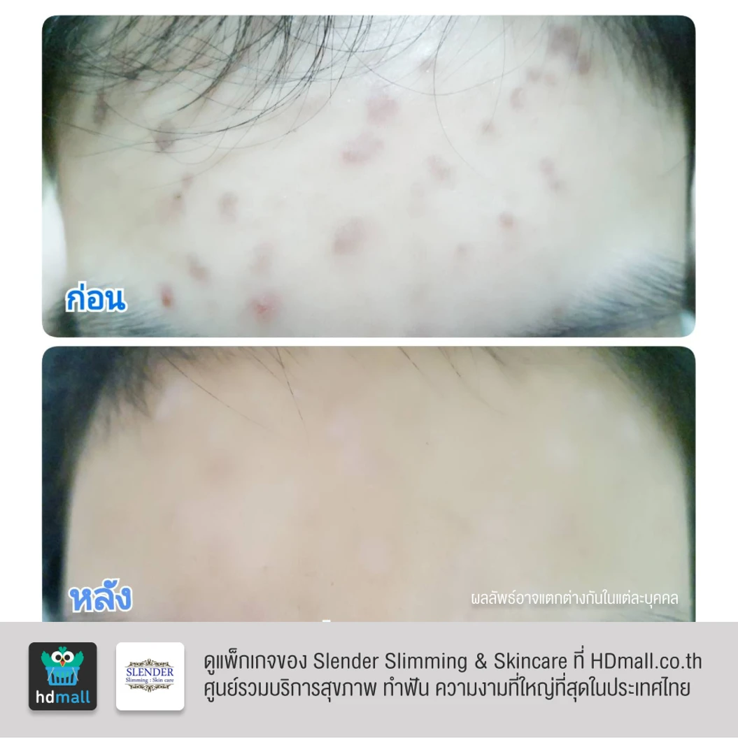 คอร์สฉายแสงฆ่าเชื้อสิว ด้วย Blue Light Laser ลดการอักเสบ ทำให้สิวฝ่อและแห้งลง 2 ครั้ง