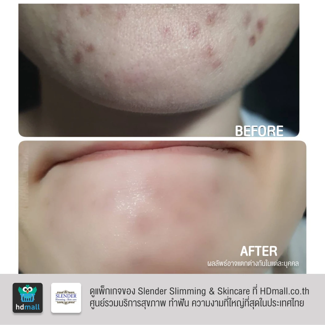 คอร์สฉายแสงฆ่าเชื้อสิว ด้วย Blue Light Laser ลดการอักเสบ ทำให้สิวฝ่อและแห้งลง 2 ครั้ง