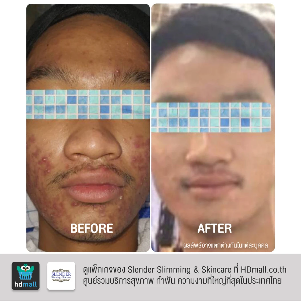 คอร์สฉายแสงฆ่าเชื้อสิว ด้วย Blue Light Laser ลดการอักเสบ ทำให้สิวฝ่อและแห้งลง 2 ครั้ง