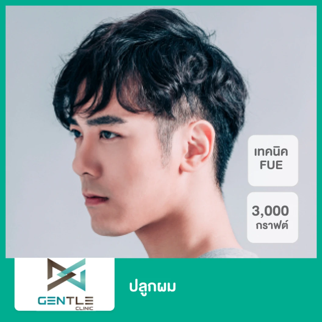 ปลูกผม ด้วยเทคนิค FUE 3,000 กราฟต์