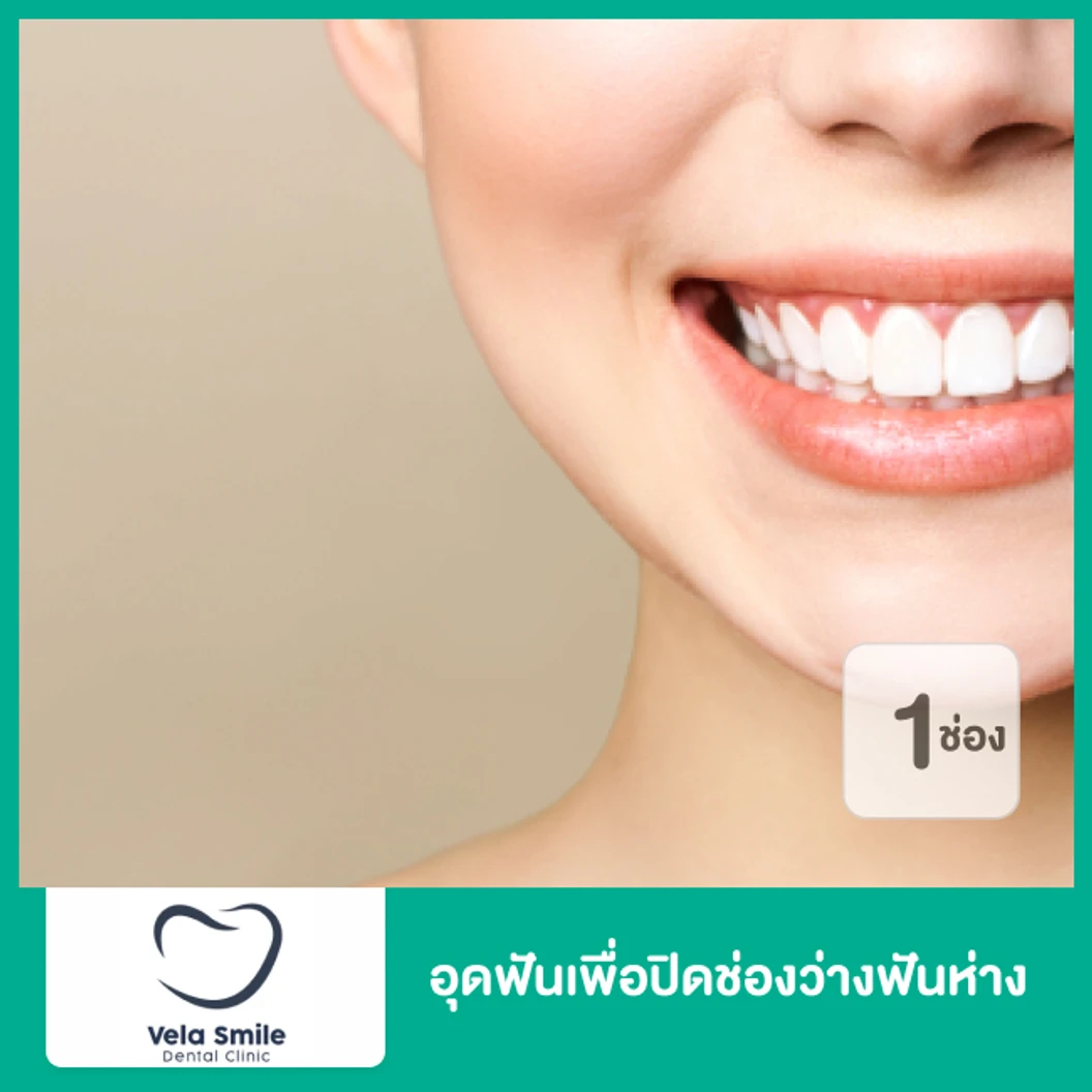 อุดฟันเพื่อปิดช่องว่างฟันห่าง 1 ช่อง