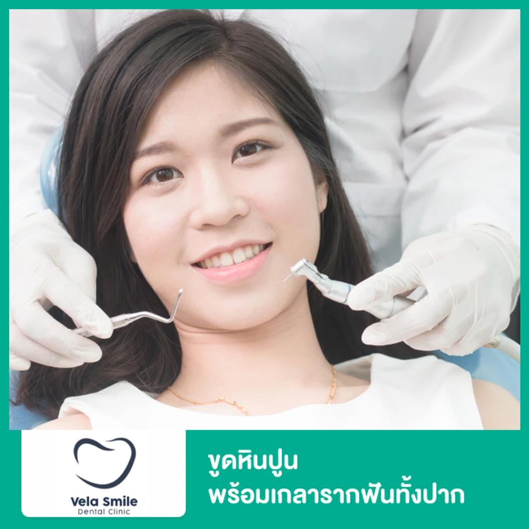 ขูดหินปูน พร้อมเกลารากฟันทั้งปาก