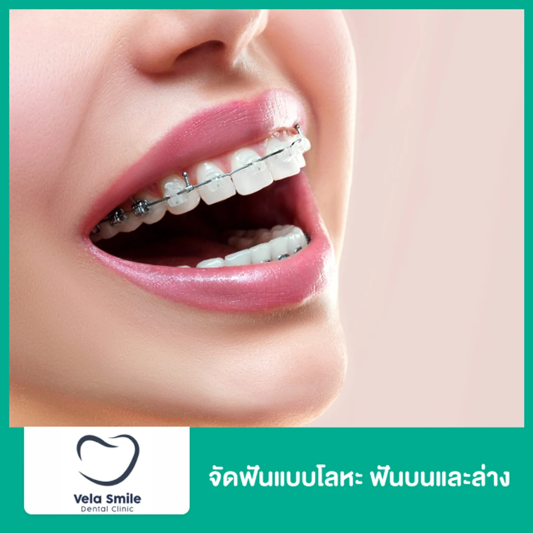 จัดฟันแบบโลหะ ฟันบนและล่าง